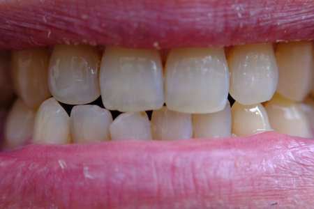 Close-up of a woman's mouth with white teeth. Dental care concept.