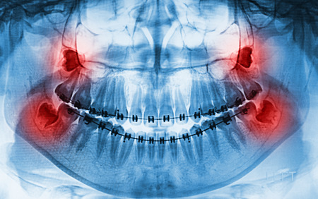 X-Ray scan human for teeth 