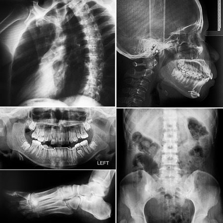 Collage of human X-rays photo