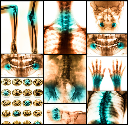 Collage of human X-rays photoの写真素材