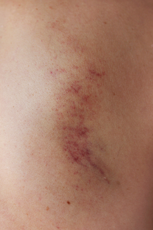bruises that remain after the ancient Chinese method of massage with a scraper. back area.の写真素材