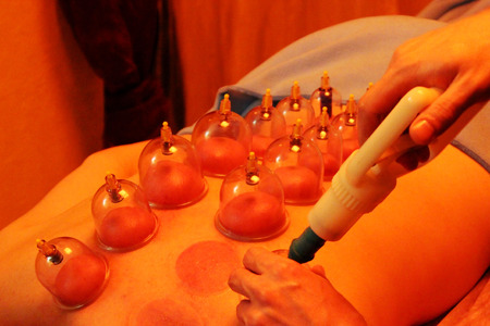 therapeutic and prophylactic massage with massage cans and man, who provides massages professionally. reportage.の写真素材