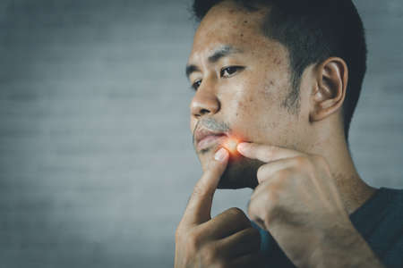 Man with acne problem squishing pimples. Man pointing acne Inflamed occur on his face.の写真素材