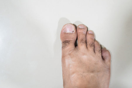 Ingrown nails is Inflamed fingernails with pus on floor. Toenail problems on gray backgroundの写真素材