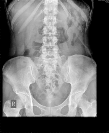 X-ray of the abdomen の写真素材