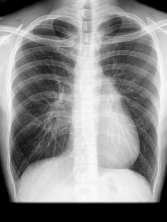 X-ray of the chestの写真素材