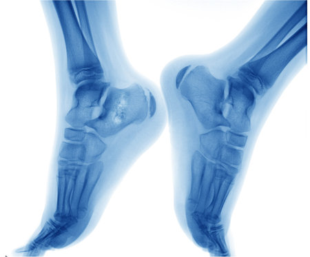 Bone cancer 