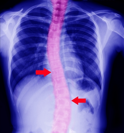 X ray of Curved Spine の写真素材