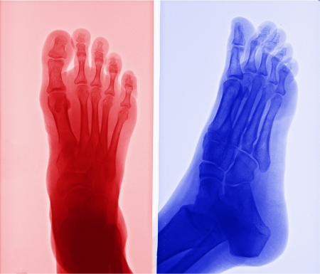 X-ray picture of foot の写真素材