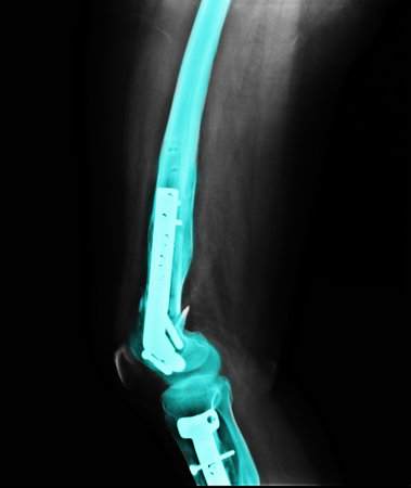 x ray of fractures bone 