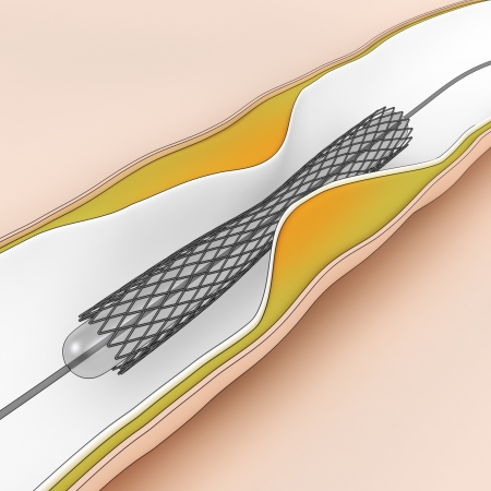 Coronary Angioplasty procedure - plague blocking blood flowの写真素材