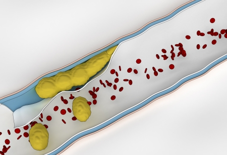 Formation of Plaque in the Arterial Wall - cholesterol travel in bloodの写真素材
