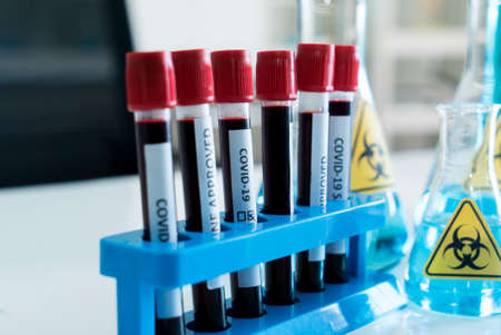 covid-19 blood test in glass tube at medical laboratory.の写真素材