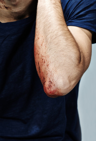 Wounded arm with bloodの写真素材