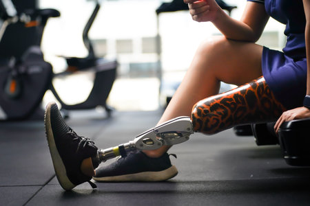 Young female with one prosthetic leg with the practice of using prosthetic legs to walk, exercise...