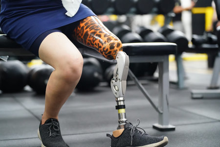 Young female with one prosthetic leg with the practice of using prosthetic legs to walk, exercise...