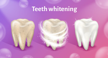 Tooth before, in process and after whitening. Teeth whitening in realistic 3d vector illustration.のイラスト素材