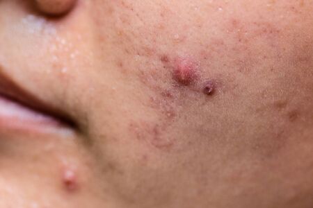Young Asia woman showing her face with acne and moles