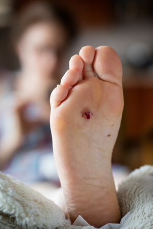 Wounded female foot. A wound from the nail that pierced the shoe. Light background.の写真素材