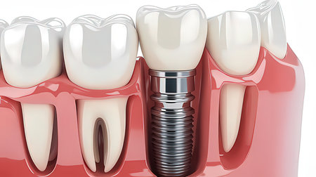 3d render of teeth with dental implant. Dental care conceptの素材