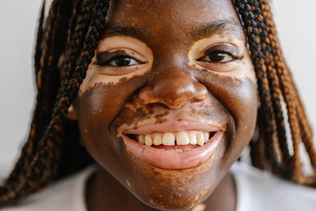 Close-up view portrait of young woman with vitiligo smile at cameraの写真素材