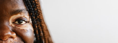 Young woman with vitiligo smile at camera over white backgroundの写真素材