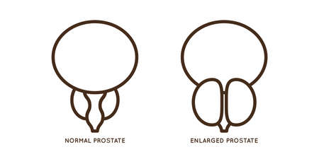 Cartoon benign and prostate vector illustration. Icon character of male urology inflammation disease. Flat design for diagram, medical journal article. Prostatitis, enlarged,obstruction,hypertrophyのイラスト素材
