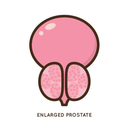 Cartoon benign and prostate vector illustration. Icon character of male urology inflammation disease. Flat design for diagram, medical journal article. Prostatitis, enlarged,obstruction,hypertrophyのイラスト素材