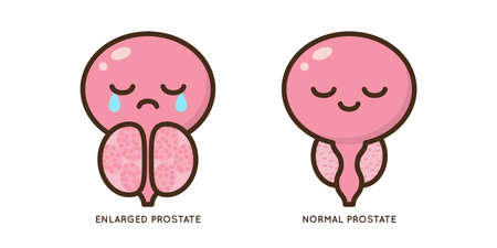 Cartoon benign and prostate vector illustration. Icon character of male urology inflammation disease. Flat design for diagram, medical journal article. Prostatitis, enlarged,obstruction,hypertrophyのイラスト素材