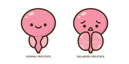 Cartoon benign and prostate vector illustration. Icon character of male urology inflammation disease. Flat design for diagram, medical journal article. Prostatitis, enlarged,obstruction,hypertrophyのイラスト素材