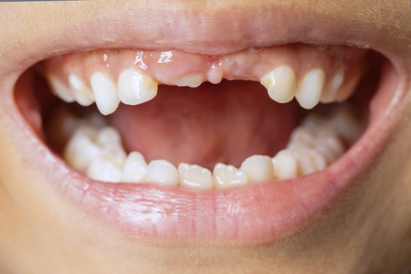 Closeup of unknown child is showing her lost first milk teeth