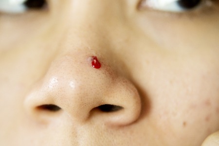 Close up of young woman skin face with a bleed acne on her noseの写真素材