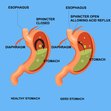 GERD problem isometric 3d vector illustration concept for banner, website, illustration, landing page, flyer, etc.のイラスト素材