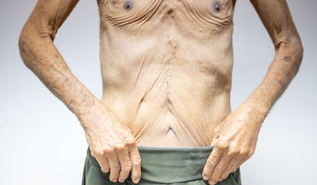 The thin old man skin with close-up old skin with the surgical wound and the wrinkle old skin .の写真素材