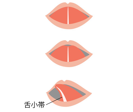 It is an illustration which drew the tongue small belt (tongue small belt shortening disease).のイラスト素材