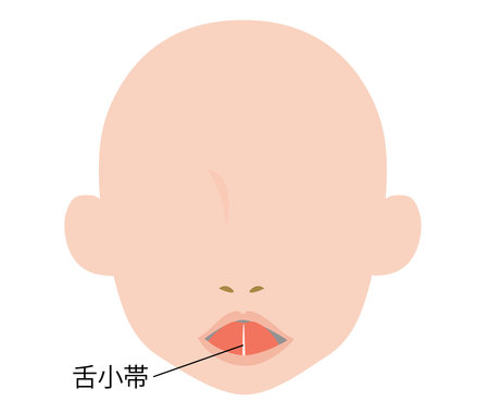 It is an illustration which drew the state of the tongue small belt (tongue small belt shortening disease).のイラスト素材
