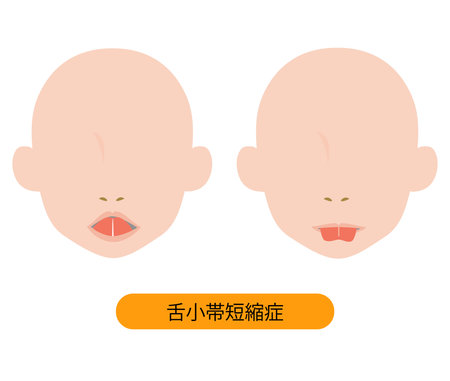 It is an illustration which drew the tongue small belt (tongue small belt shortening disease).のイラスト素材