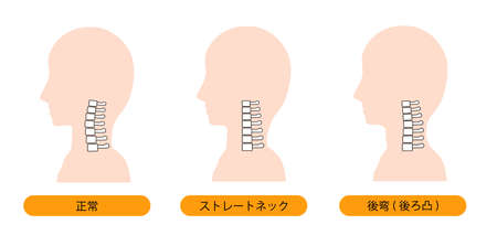 Straight neck, cervical post-vertebral bay disease, normal neck bone imageのイラスト素材