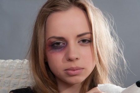 Poor young scared girl with black eye thinking about her heavy-handed father and cryingの写真素材