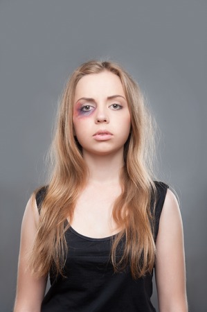 Poor young fair-haired girl with black eye wearing black shirt standing and thinking about brutality of her father  Isolated on grey backgroundの写真素材