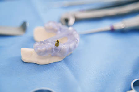 Teeth model with metal implant in dental clinic