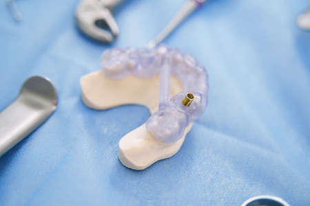 Teeth model with dental implant in stomatology clinicの写真素材