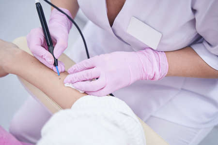 Experienced Caucasian beauty clinic doctor removing nevus on female arm