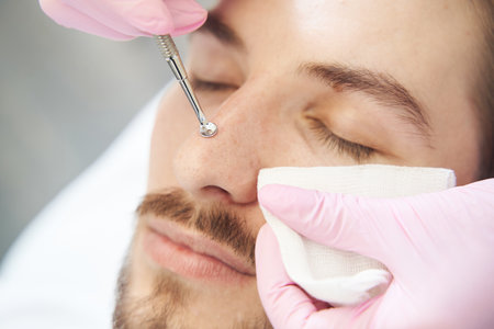 Uno spoon pressed to male nose during pores removal treatmentの写真素材