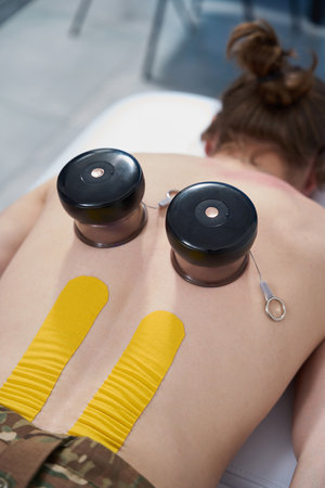 Patient in military hospital put vacuum cups on his backの写真素材