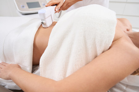 Effective smas lifting procedure on the belly of a patient in aesthetic clinicの写真素材