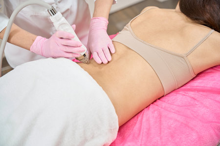 Beauty salon client undergoing RF microneedling done by cosmetologistの写真素材