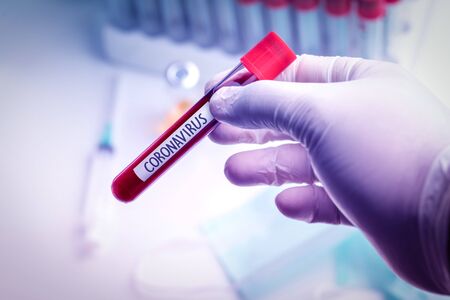 Doctor wearing medical gloves holding a blood tube with positive Coronavirus 2019-nCoV Blood Sample.