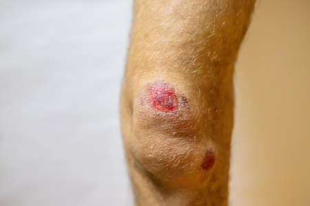 Man's leg injury, wound and blood. Selective focus. People.の写真素材