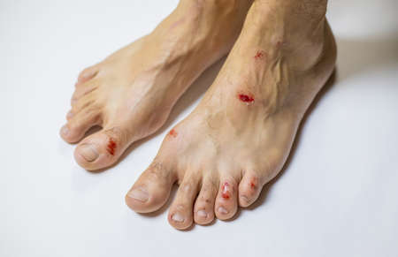 Man's leg injury, wound and blood. Selective focus. People.の写真素材